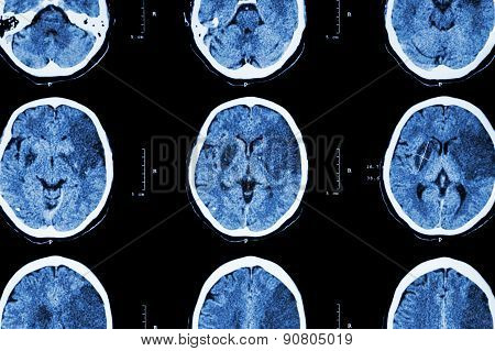 Ischemic Stroke