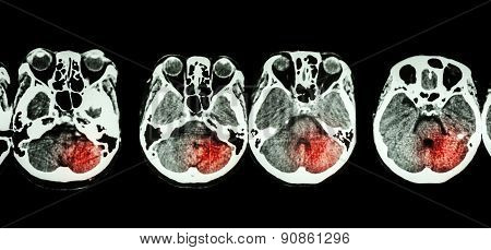 Stroke  ( Ct Scan Of Brain And Base Of Skull And Stroke )