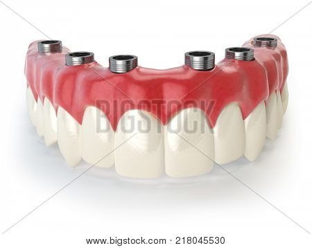 Dental prothesis isolated on white. 3d illustration