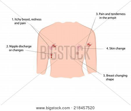 Early symptoms of breast cancer. Vector illusstration