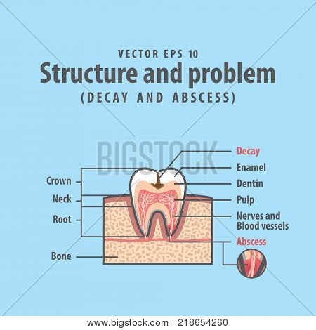 Cavitys Tooth Cross-section Structure Inside Tooth Diagram And Chart Illustration Vector On Blue Bac