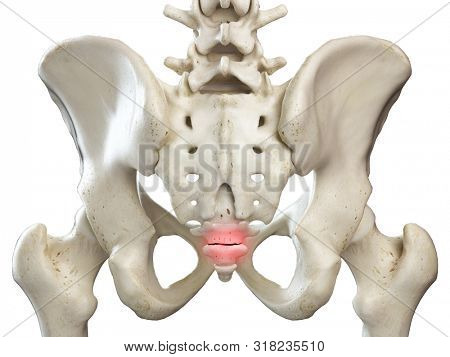 3d rendered medically accurate illustration of a broken coccyx