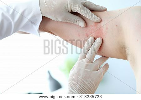 Male Doctor In White Latex Gloves Examines Patient With Skin Disease Against Office Background. Alle