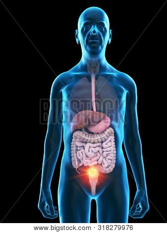 3d rendered medically accurate illustration of an old mans digestive tumor
