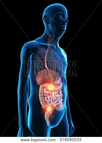 3d rendered medically accurate illustration of an old mans digestive system tumor
