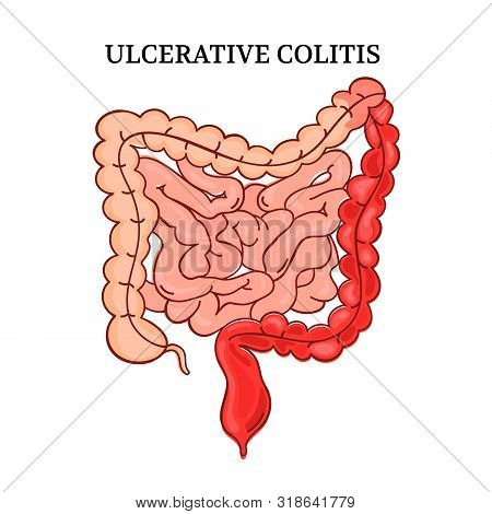 Ulcerative Colitis Intestines Education Medicine Anatomy Scheme Human Handdraw Vector Illustration