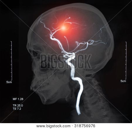 Mri Of The Blood Vessels In The Brain And Cerebrovascular Disease Or Or Hemorrhagic Stroke. Brain St