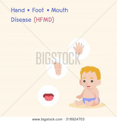 Children Infected, Boy Have A Blister Hand Foot Mouth Disease, Hfmd In Rain Season, Medical Health C