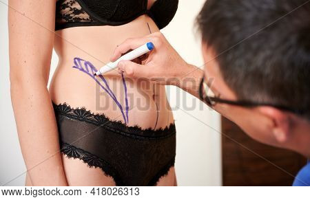 Close Up Of Plastic Surgeon Hand Drawing Marks On Female Patient Body Before Aesthetic Surgery. Youn