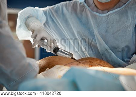 Cosmetic Liposuction Surgery In Actual Operating Room Setting Showing Surgeons Group During Operatio
