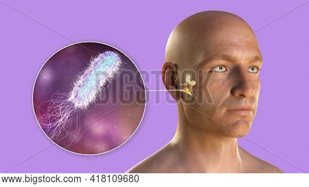 Pseudomonas Aeruginosa Bacterium As A Cause Of Otitis Media. 3d Illustration Showing Purulent Inflam