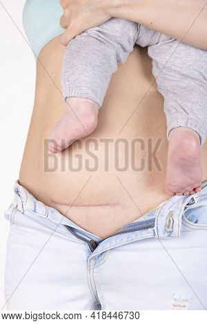 Close-up Of A Woman's Belly With A Cesarean Section Scar, Five Months After Giving Birth. Woman With