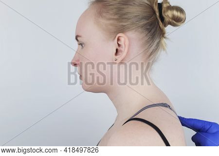Kyphosis. The Woman Suffers From A Curvature Of The Spine In The Upper Section. The Cervical Vertebr