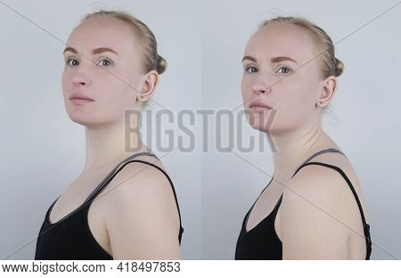 Before And After Kyphosis. The Woman Suffers From A Curvature Of The Spine In The Upper Section. The