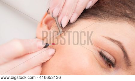 Woman On Electro-epilation Of The Face. Hardware Permanent Removal Of Unwanted Hair In The Salon