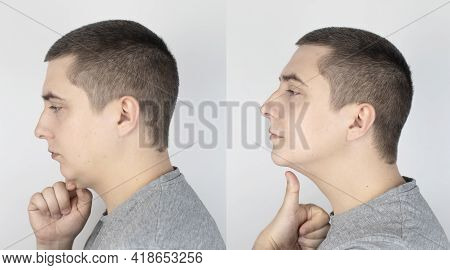 Double Chin Lift. Before And After Plastic Surgery, Mentoplasty Or Face-building. Chin Fat Removal A