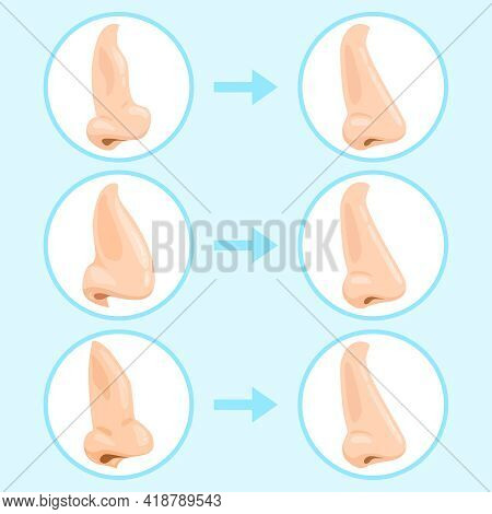 Cartoon Rhinoplasty Surgery. Rhinoplasty Before And After, Nose Plastic Surgery Result. Rhinoplasty 