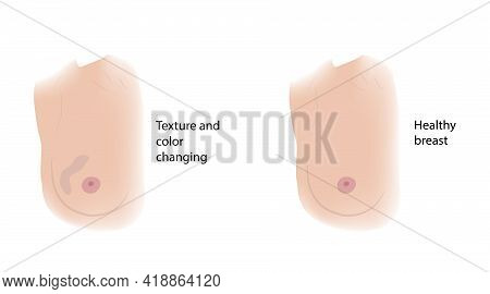 Woman Healthy Breast And Texture And Color Changing. Comparison. Medical Vector Illustration.