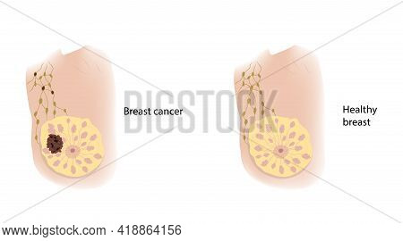 Woman Healthy Breast And Cancer. Comparison. Medical Vector Illustration.