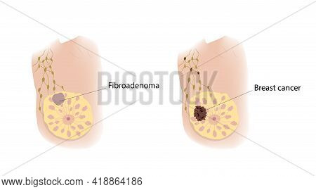 Woman Breast. Cancer And Fibroadenoma. Comparison. Medical Vector Illustration.