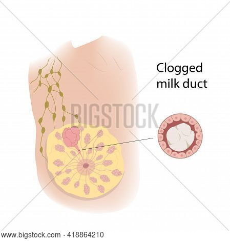 Woman Breast. Clogged Milk Duct View With Description. Medical Vector Illustration.
