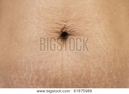 Stretch Marks