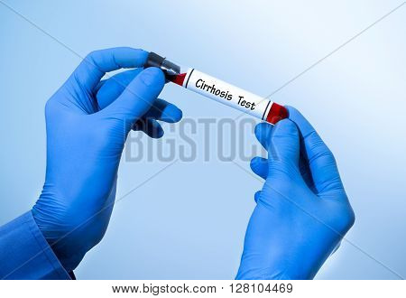Positive result of blood test for cirrhosis. Test tube with a blood test in the doctor's hands. Medical concept.