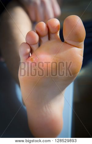 Calluses On Foot