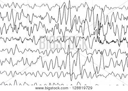Electroencephalography test that shows electrical activity of the brain.