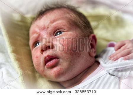 Baby Acne On Face Of Newborn. Close Up View