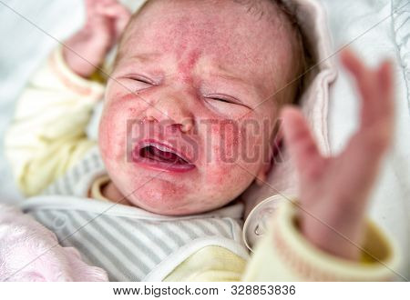 Crying Newborn With Acne Neonatorum On Face
