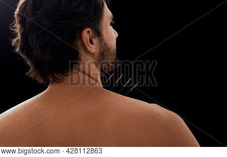 Acupuncture, Reflexology. Close-up View From Male Patient Back With Acupuncture Needles In His Shoul