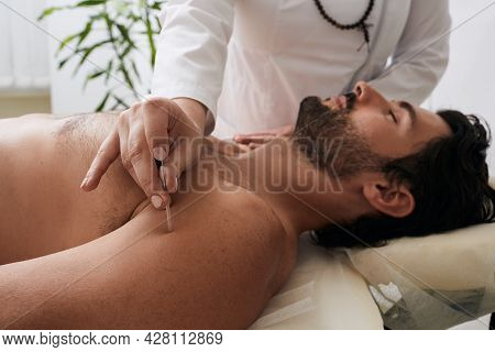Doctor Doing A Puncture With Acupuncture Needle A Point On The Patients Shoulder To Treat Pain And I