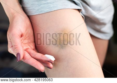 A Young Woman Applies A Healing Cream To A Bruise On The Leg. Treating A Bruise At Home. Domestic Vi