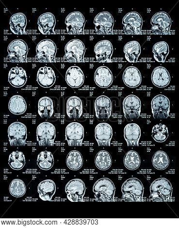 Mri Scan Image Of A Human Brain Showing All Main Multiple Sclerosis Details