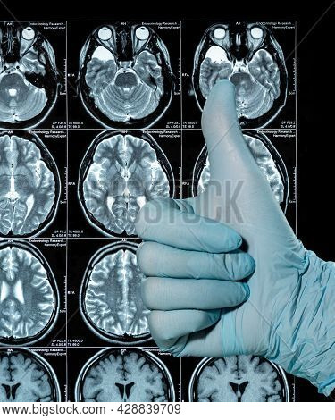 Mri Scan Image Of A Human Brain Showing All Main Multiple Sclerosis Hand In Bliue Glove Thumbs Up