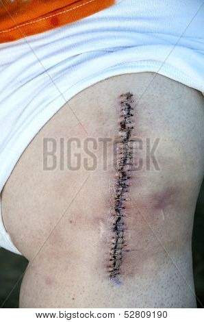 Total Knee Replacement