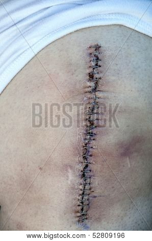 Total Knee Replacement