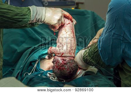 Childbirth In Operation Room C-section Surgery