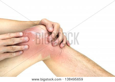 Man apply lotion on sunburnt knee skin isolated on white background