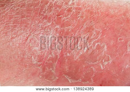 Psoriasis Skin.