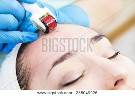 The Woman Undergoes The Procedure Of Medical Micro Needle Therapy With A Modern Medical Instrument D
