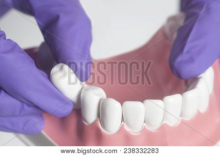 Dental Model Teeth Is Used To Demonstration Of Tooth Extraction By Doctors Isolated On A White Backg