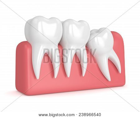 3D Render Of Teeth With Wisdom Mesial Impaction