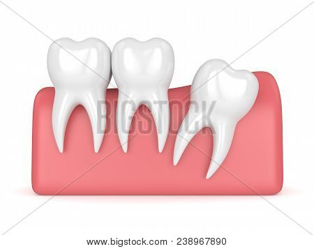 3D Render Of Teeth With Wisdom Distal Impaction