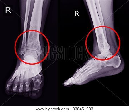X-ray Rt.ankle Finding Intramedullary Osterolytic Lesion Of Right Distal Tibia.  No Periosteal React