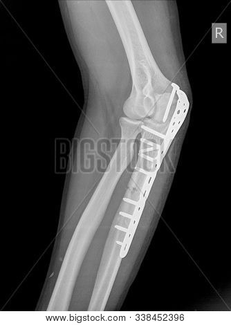 X-ray Elbow An Olecranon Fracture My Be Held Together With Plate And Screws.