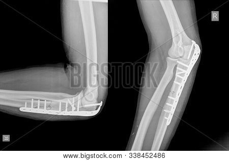 X-ray Elbow An Olecranon Fracture My Be Held Together With Plate And Screws.this Is Called A Tension
