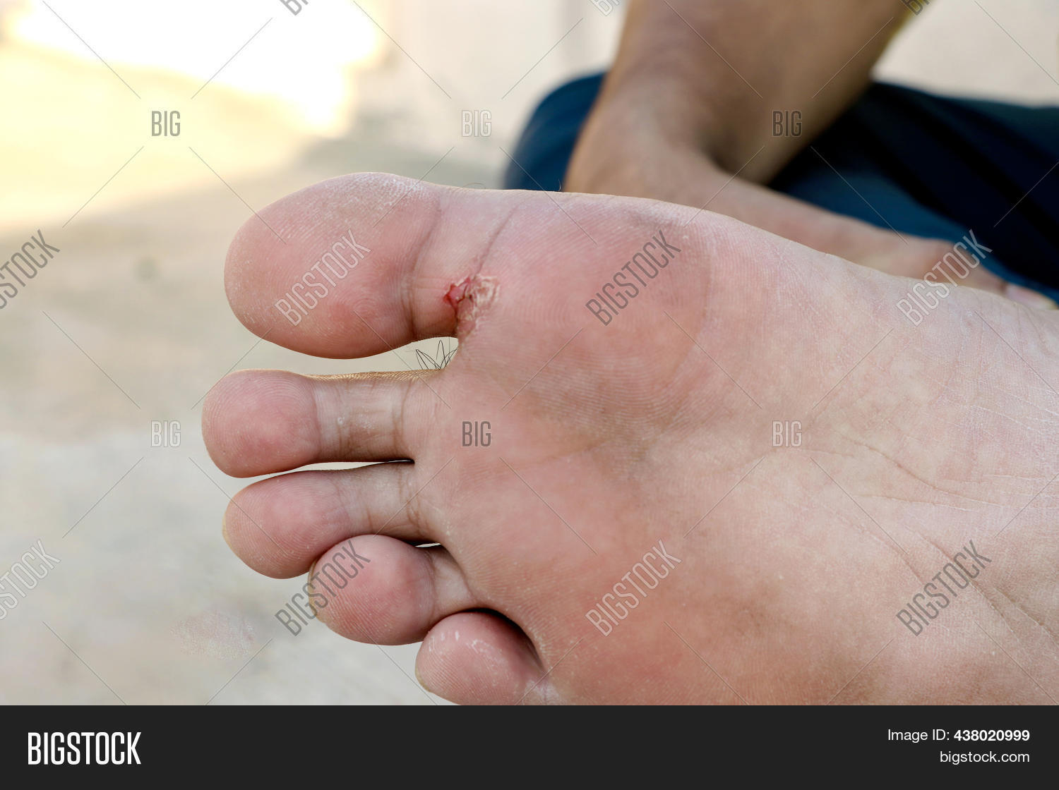 Athlete's Foot Tinea Image & Photo (Free Trial) Bigstock