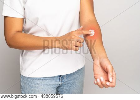 Allergic Reaction, Itch, Allergy, Dermatiti Concept. Closeup Of Woman Applying Cream Or Ointment On 